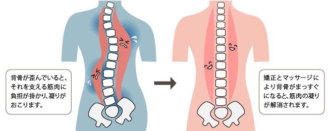背骨の歪みと筋肉の凝り