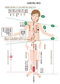 左脚が長い場合