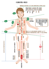 右脚が長い場合